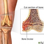 knee-bone-bruise