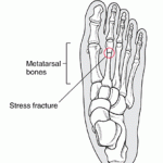 stress-fracture-foot