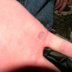 how-to-treat-a-hand-blister-kerry-wood-photo